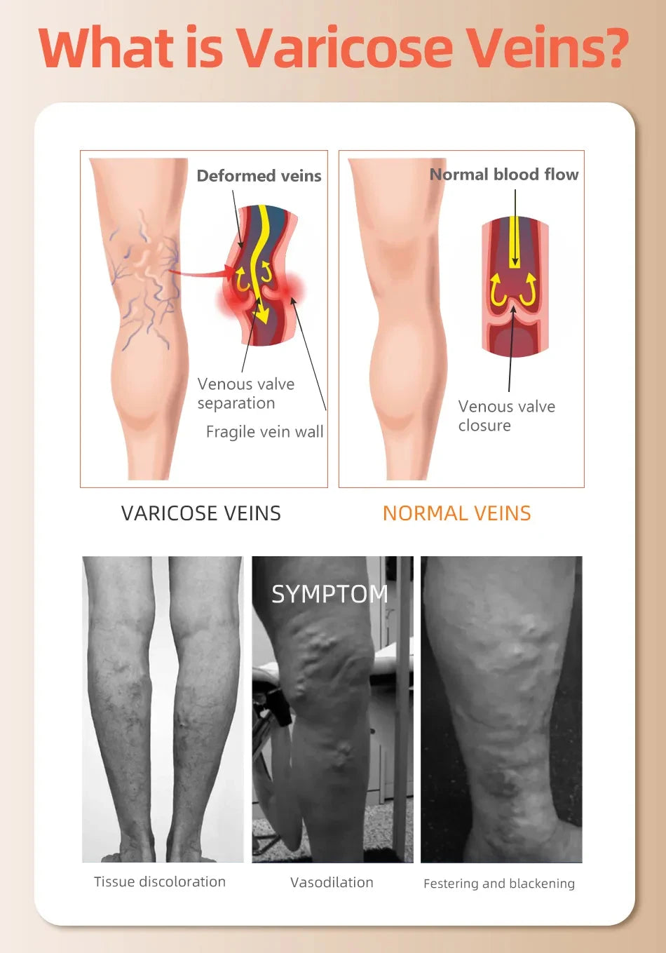 1Pair Thigh High Compression Stockings for Women,Open Toe, 20-30 mmHg Graduated Medical Compression Stockings for Edema
